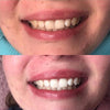 Tandblekningsupplevelse Diamond Smile - Mun med före bild Efter bild av vita tänder